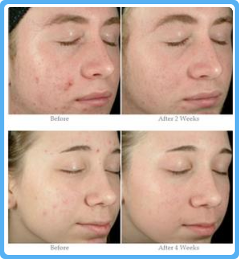 A woman with acne and different stages of treatment.