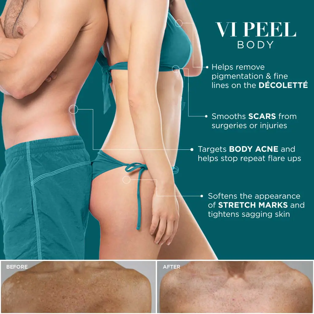 VI Peel Body Chesapeake Skin Solutions-1