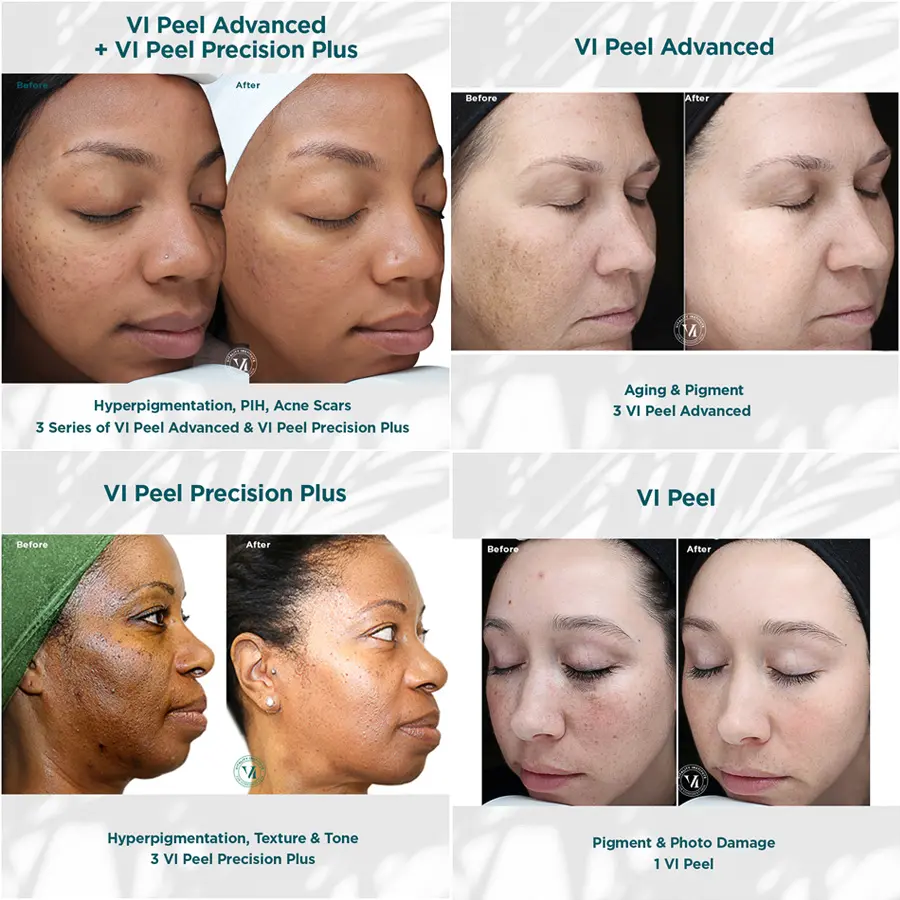 VI Peel Chesapeake Skin Solutions2